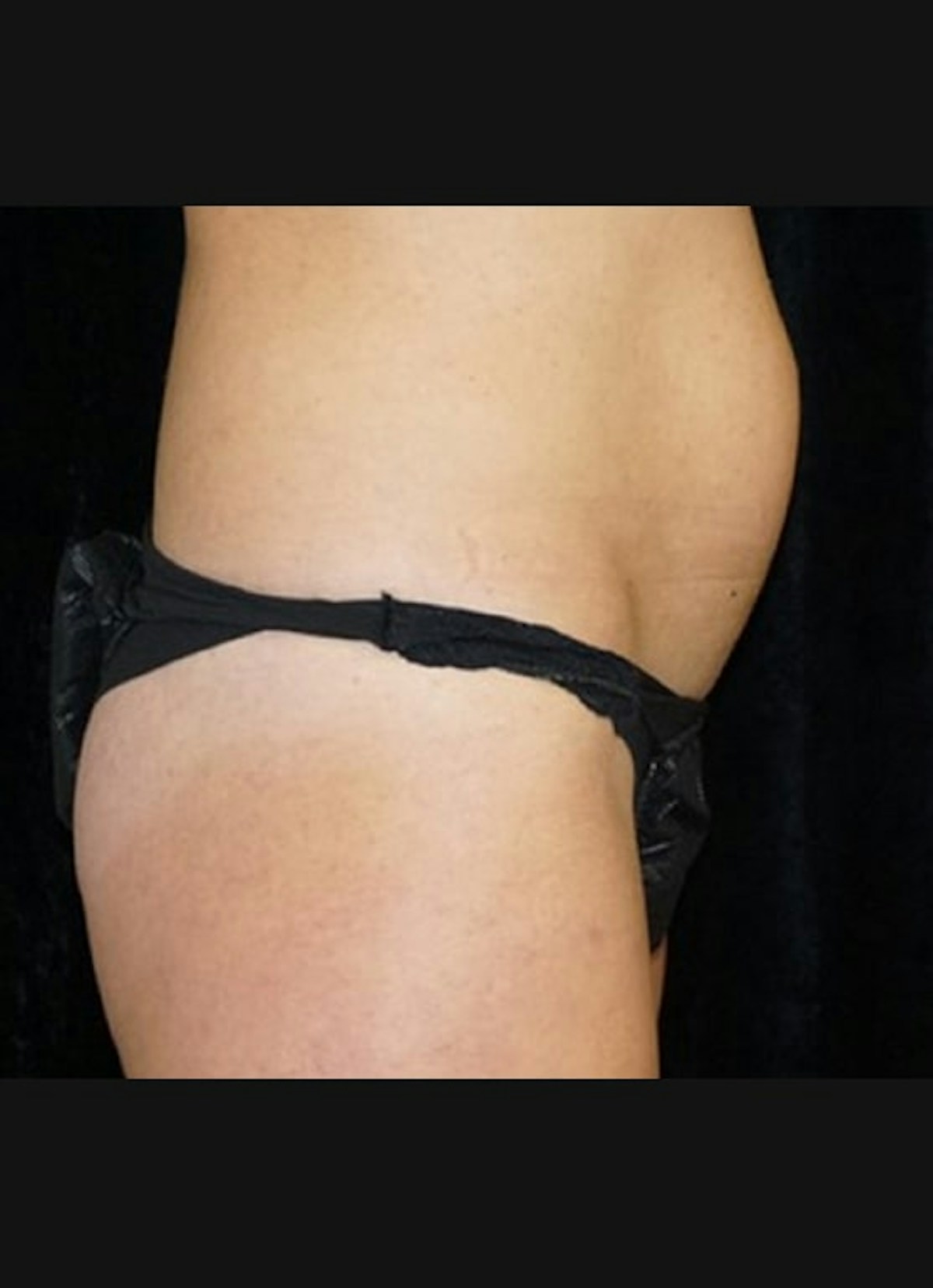 CoolSculpting Before & After Gallery - Patient 218891 - Image 5
