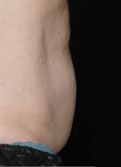CoolSculpting Before & After Gallery - Patient 286896 - Image 2