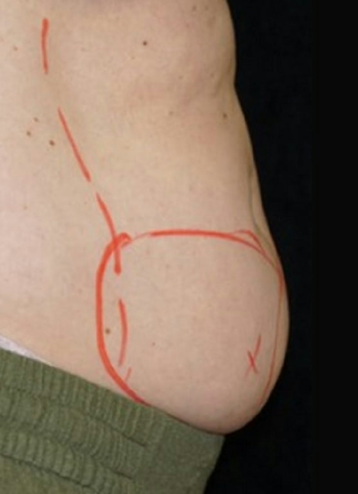 CoolSculpting Before & After Gallery - Patient 286896 - Image 1