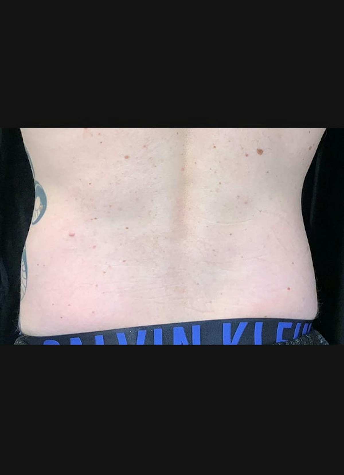 CoolSculpting Before & After Gallery - Patient 408722 - Image 2
