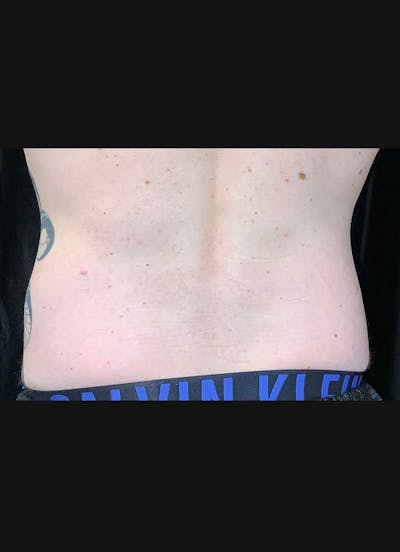 CoolSculpting Before & After Gallery - Patient 408722 - Image 2