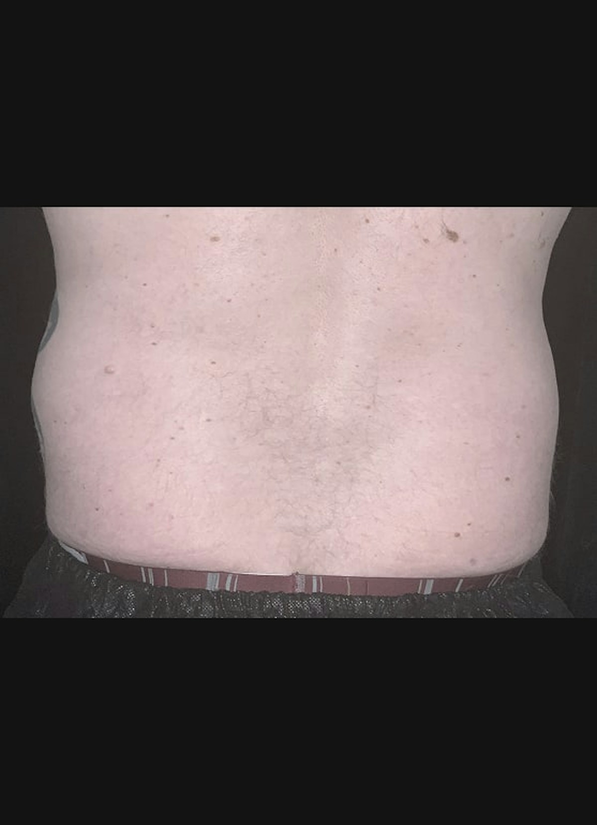 CoolSculpting Before & After Gallery - Patient 408722 - Image 1