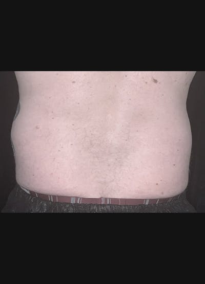 CoolSculpting Before & After Gallery - Patient 408722 - Image 1