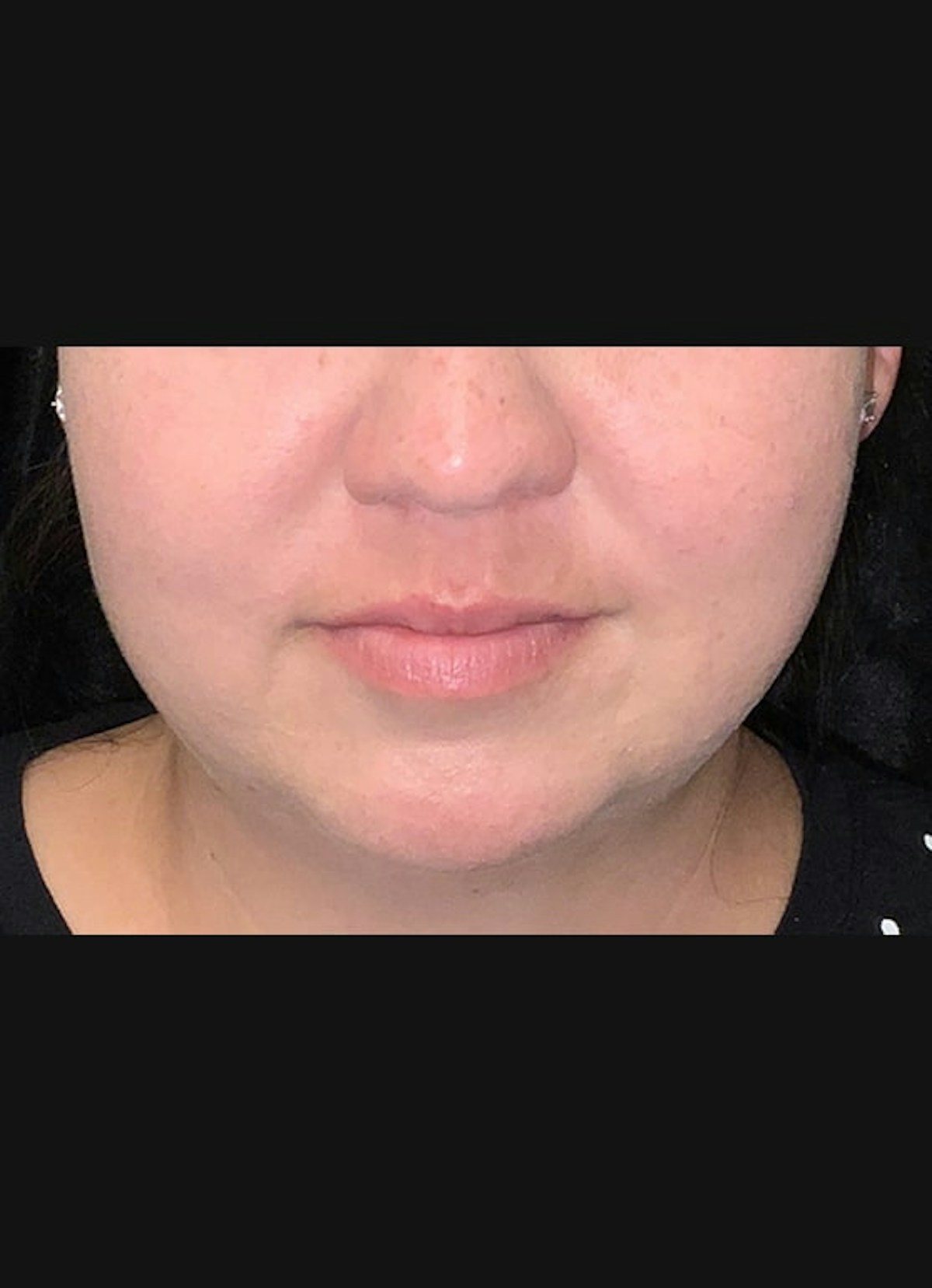 CoolSculpting Before & After Gallery - Patient 219713 - Image 2