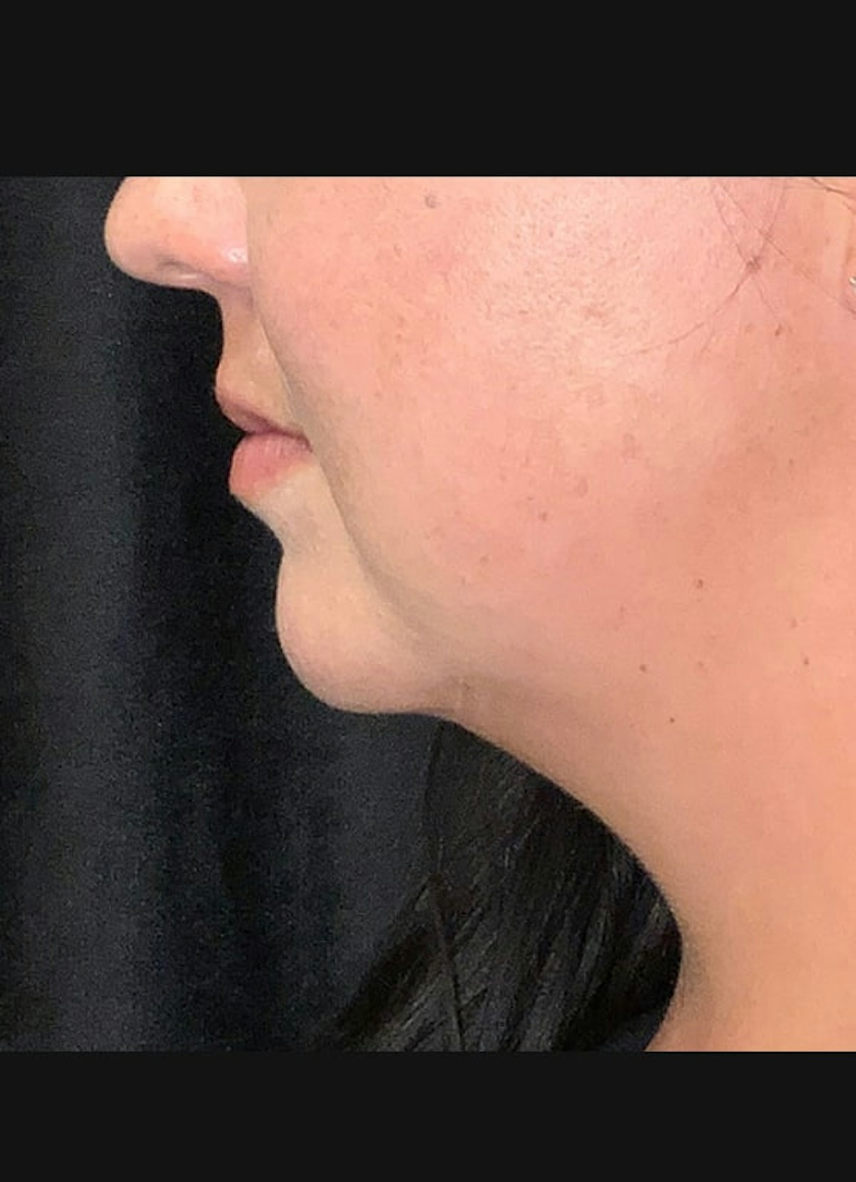 CoolSculpting Before & After Gallery - Patient 219713 - Image 4