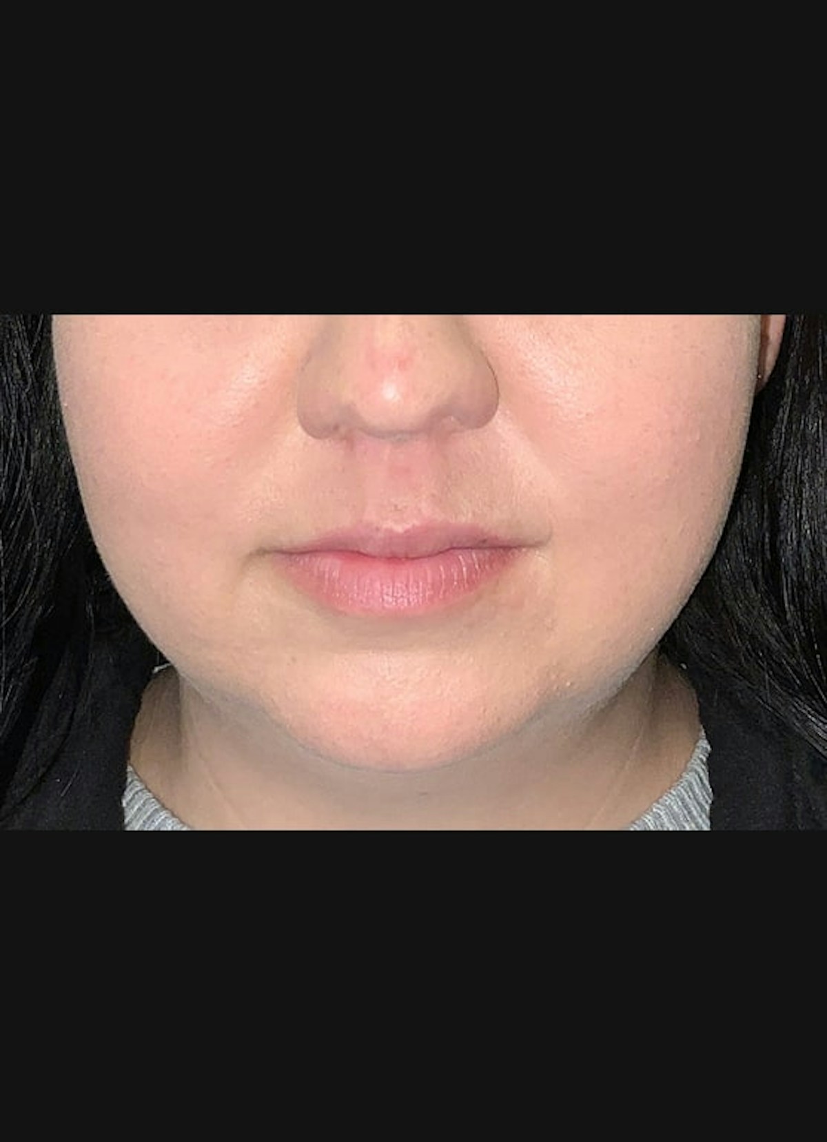 CoolSculpting Before & After Gallery - Patient 219713 - Image 1
