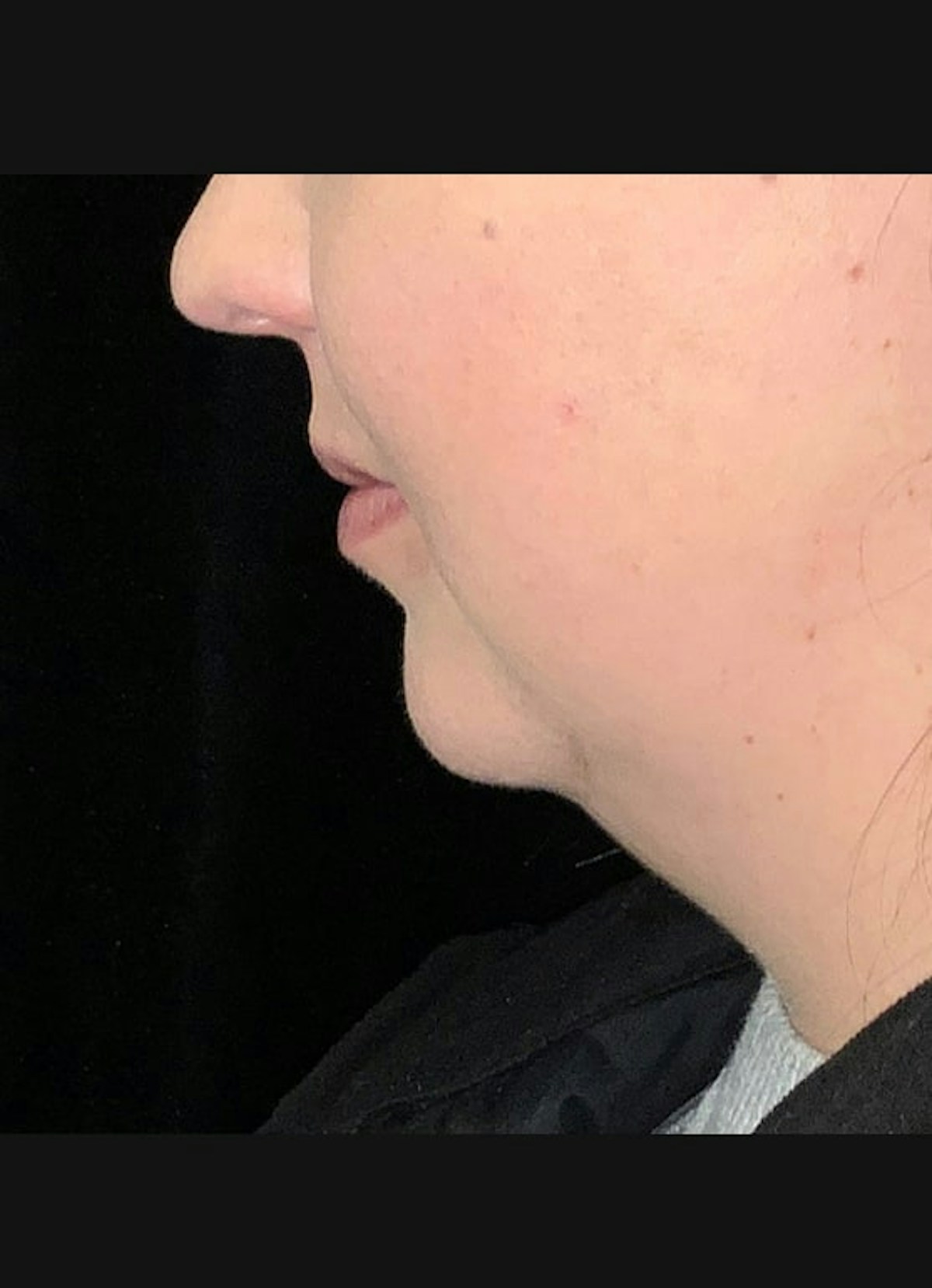 CoolSculpting Before & After Gallery - Patient 219713 - Image 3