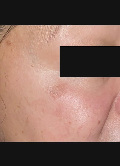 Cryotherapy Before & After Gallery - Patient 218543 - Image 2