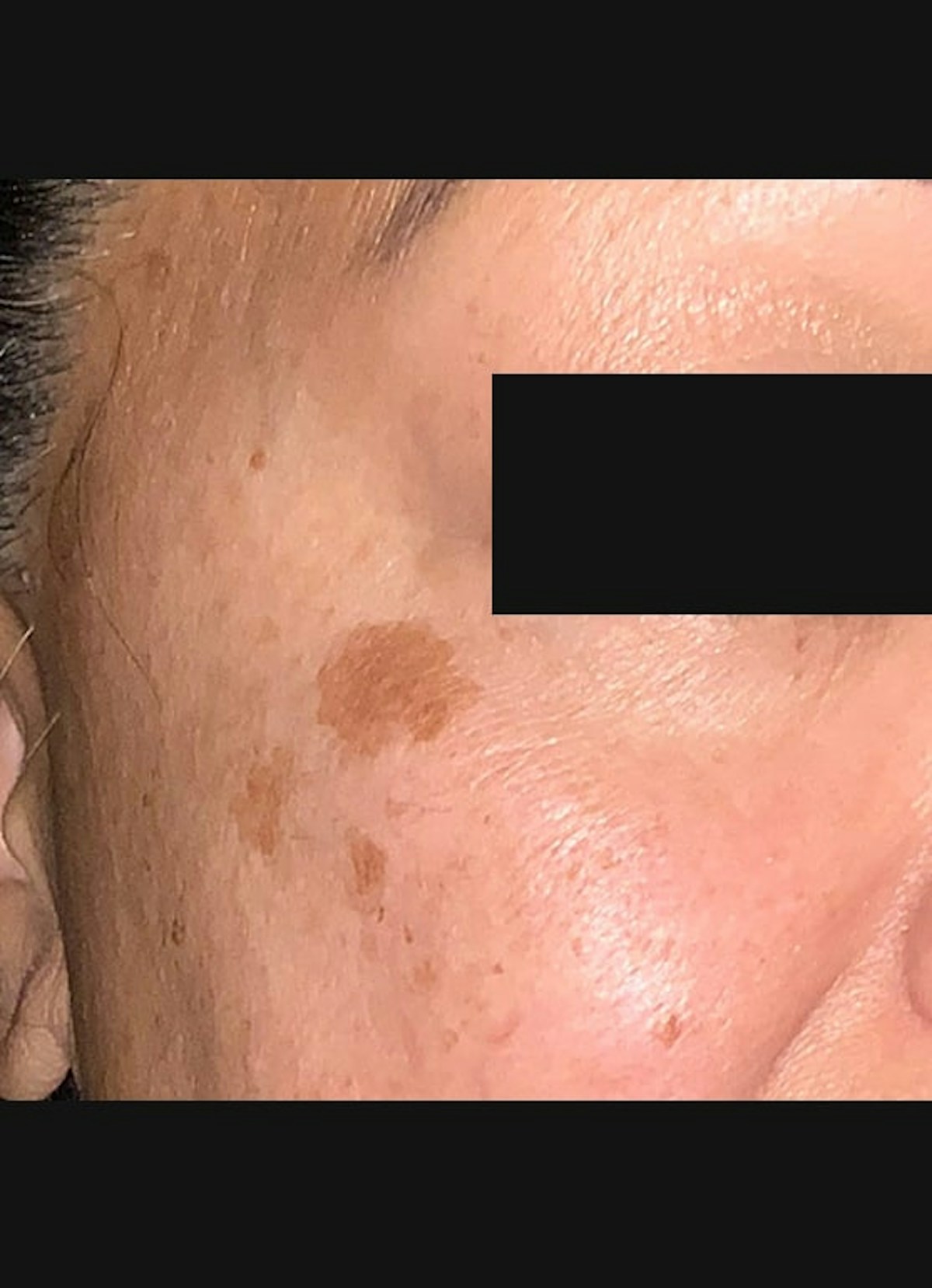 Cryotherapy Before & After Gallery - Patient 218543 - Image 1