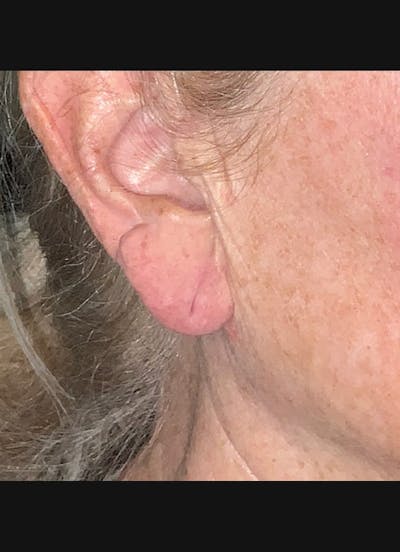 Earlobe Repair Before & After Gallery - Patient 526833 - Image 2