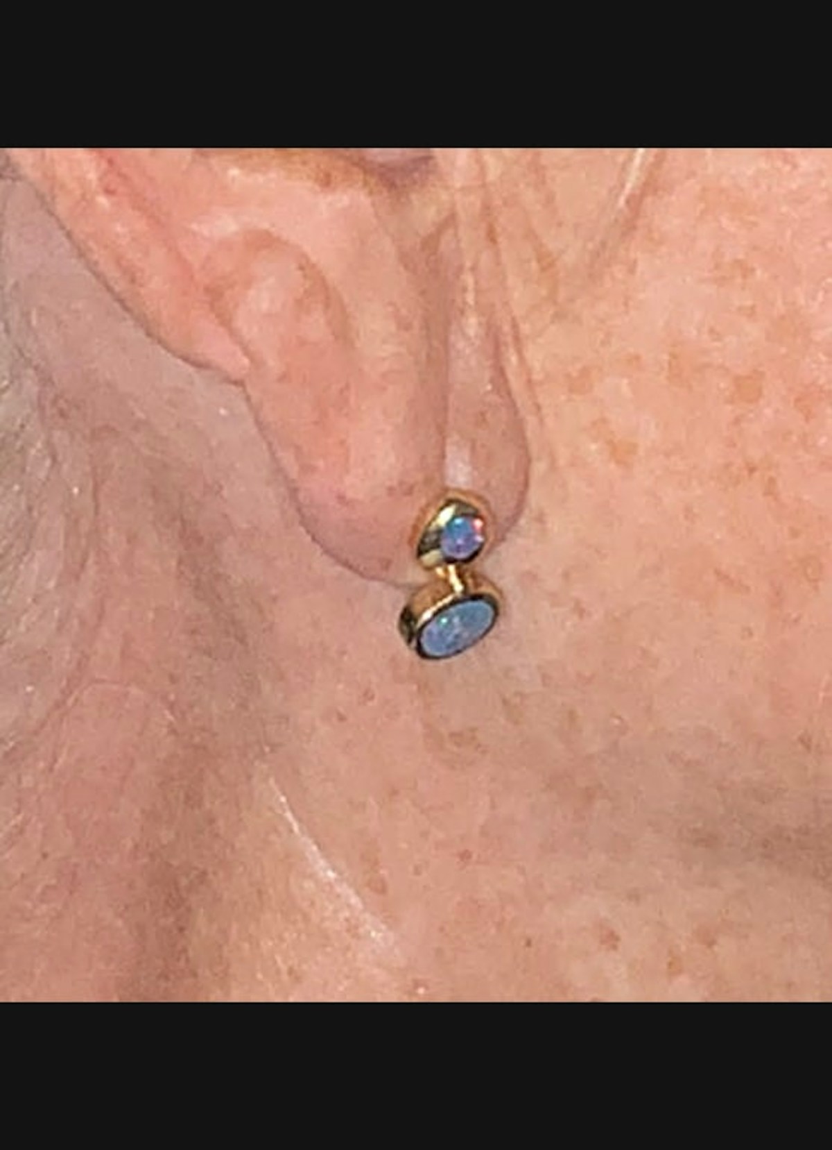 Earlobe Repair Before & After Gallery - Patient 526833 - Image 4