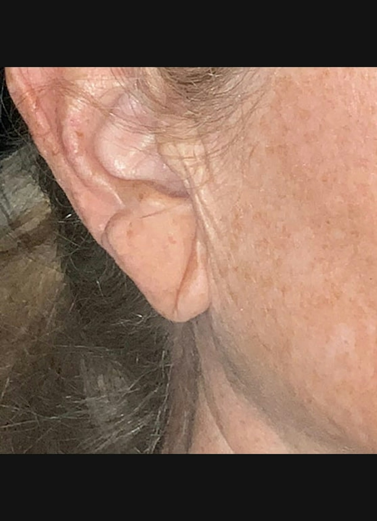 Earlobe Repair Before & After Gallery - Patient 526833 - Image 1