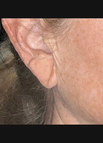 Earlobe Repair Before & After Gallery - Patient 526833 - Image 1
