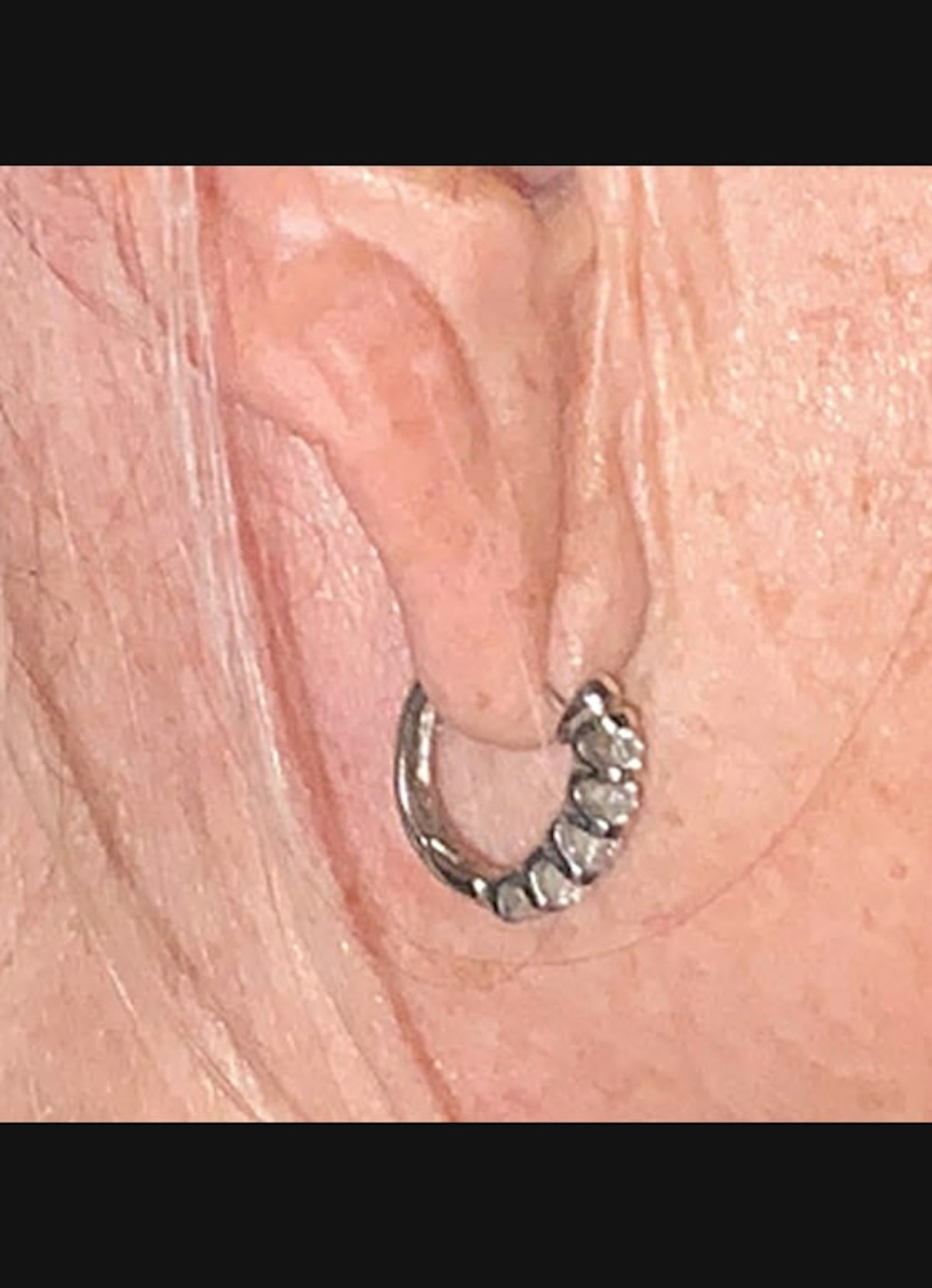 Earlobe Repair Before & After Gallery - Patient 526833 - Image 3