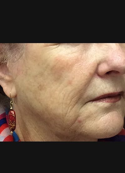 Cheeks Filler Before & After Gallery - Patient 282735 - Image 1