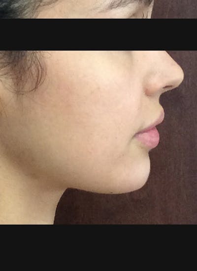 Chin for Contour Before & After Gallery - Patient 254017 - Image 2