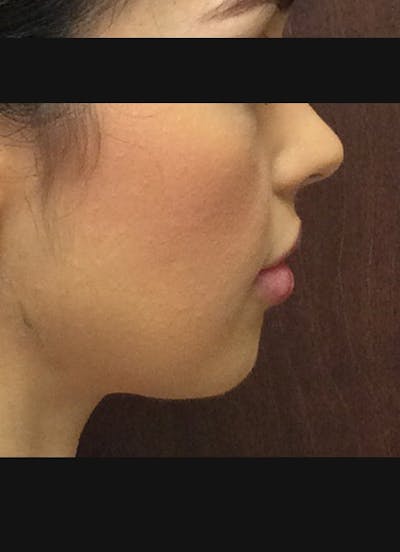Chin for Contour Before & After Gallery - Patient 254017 - Image 1