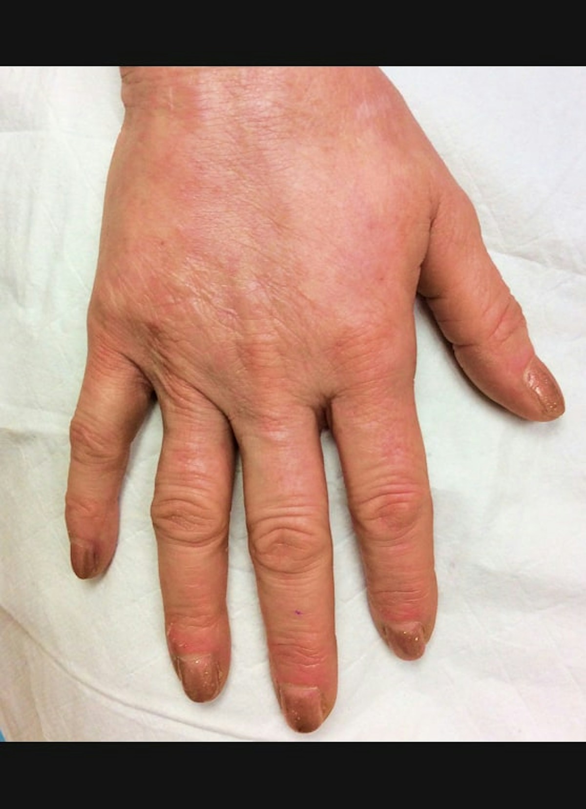 Hand Filler Before & After Gallery - Patient 902228 - Image 4
