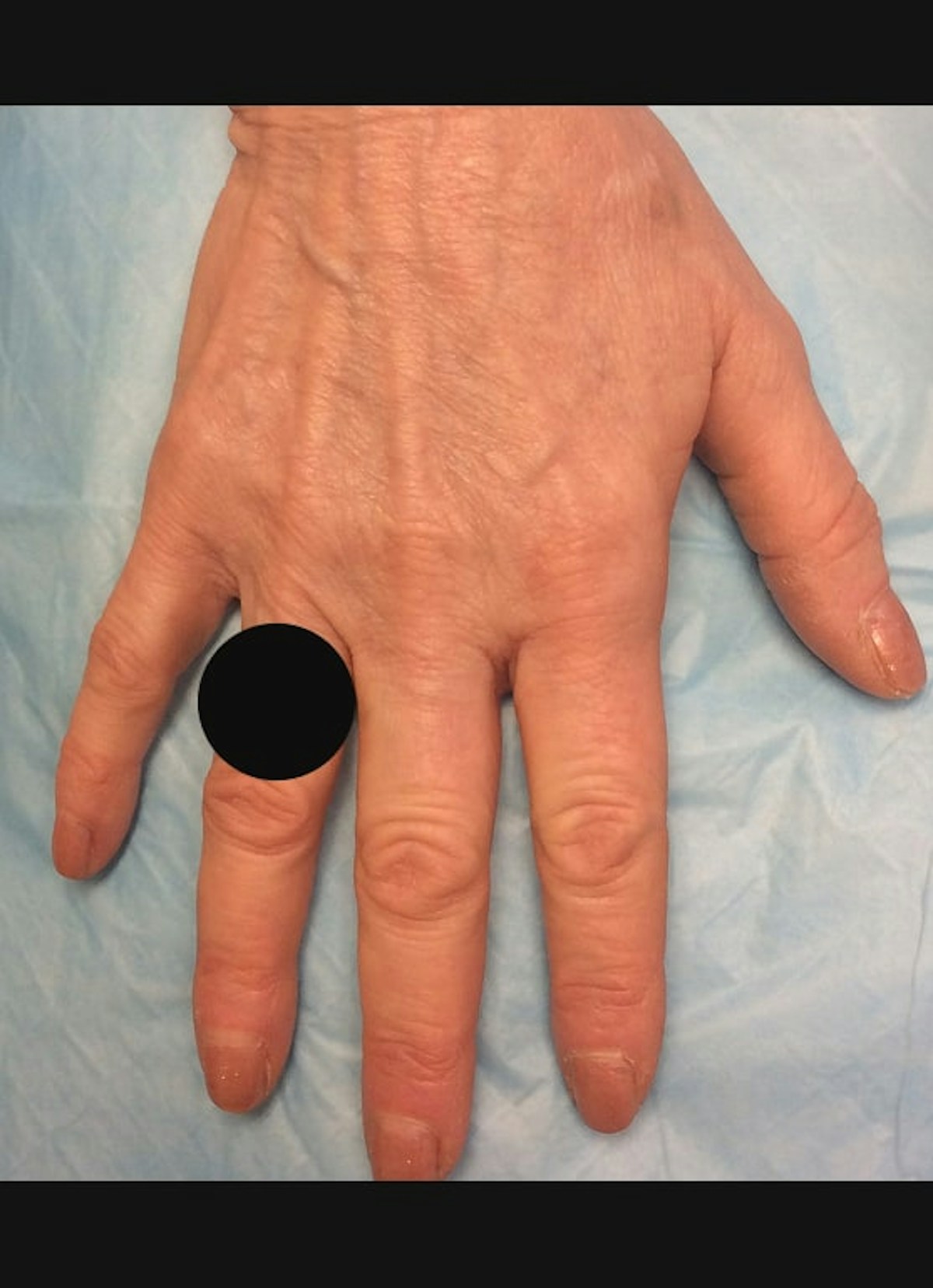 Hand Filler Before & After Gallery - Patient 902228 - Image 3