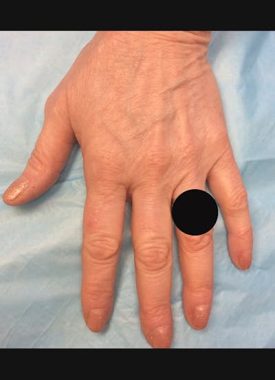 Hand Filler Before & After Gallery - Patient 902228 - Image 1