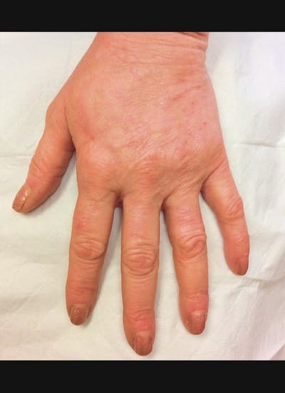 Hand Filler Before & After Gallery - Patient 902228 - Image 2