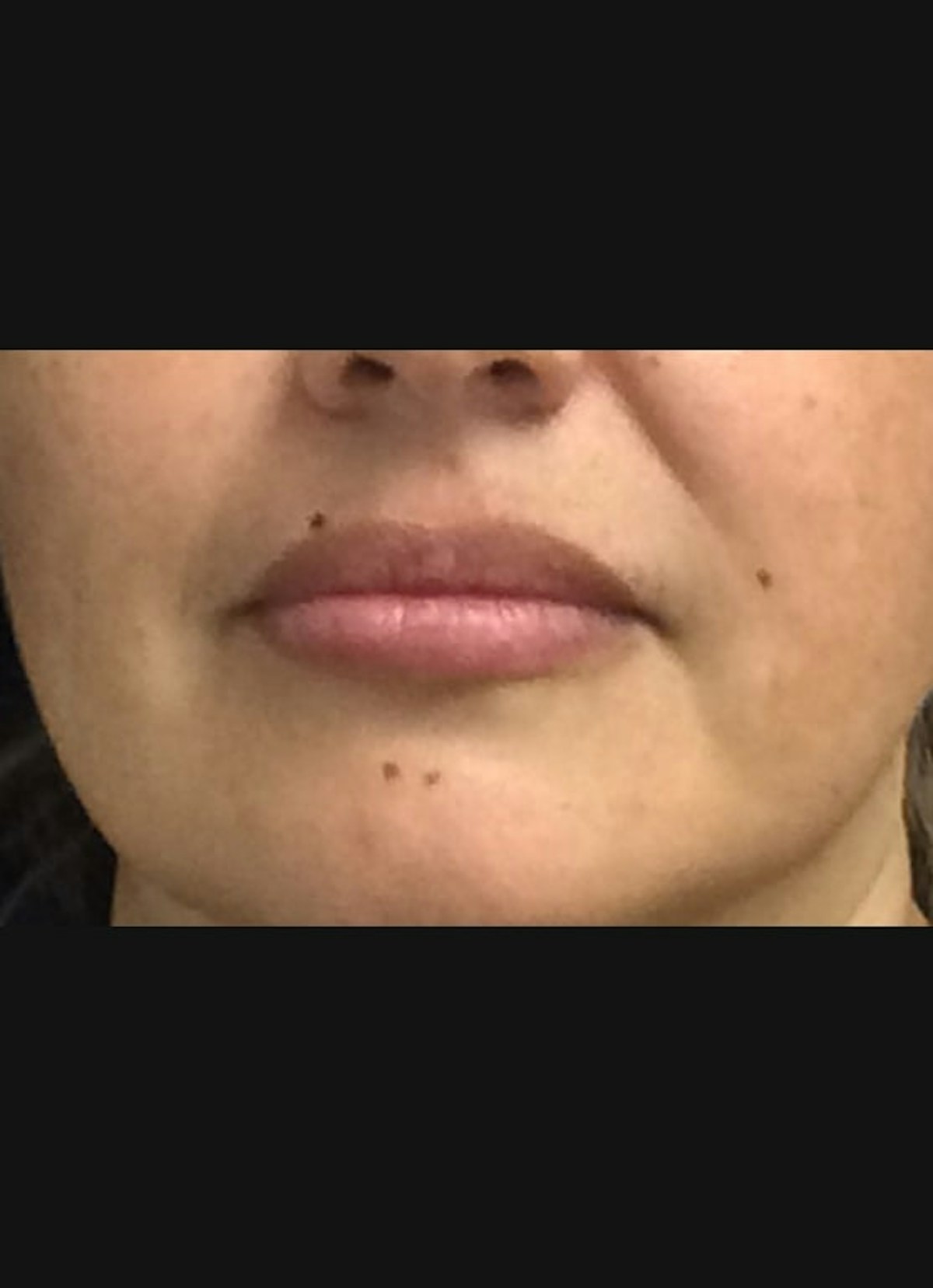 Lip Filler Before & After Gallery - Patient 185275 - Image 2