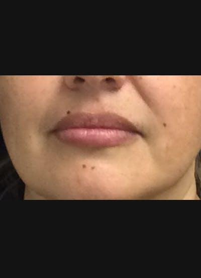 Lip Filler Before & After Gallery - Patient 185275 - Image 2