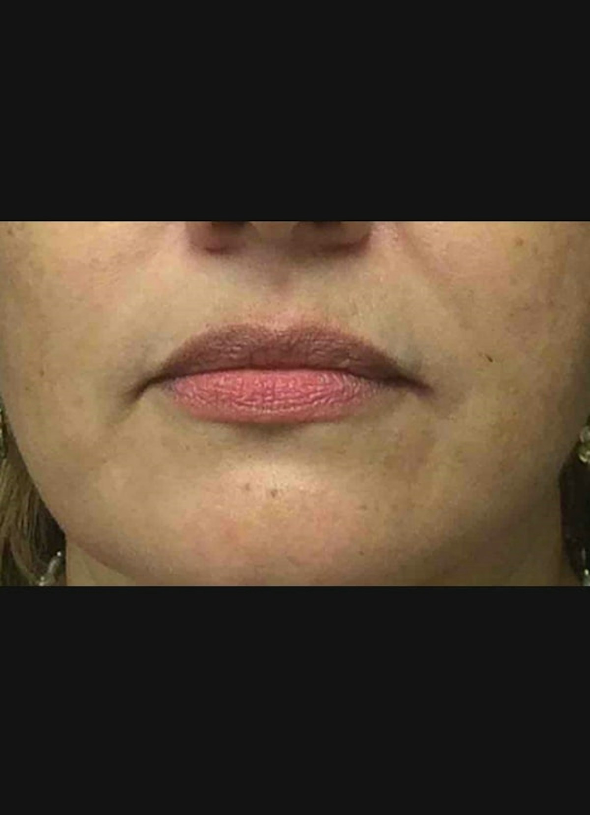Lip Filler Before & After Gallery - Patient 185275 - Image 1