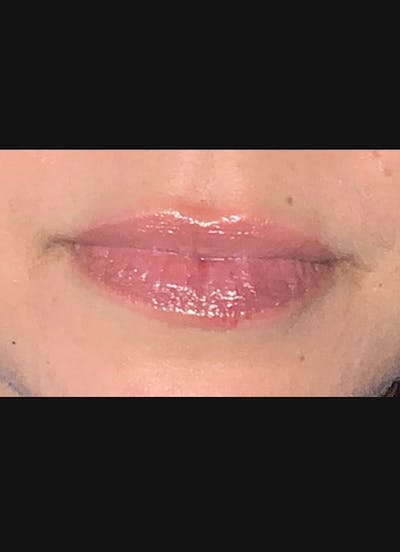 Lip Filler Before & After Gallery - Patient 104077 - Image 2