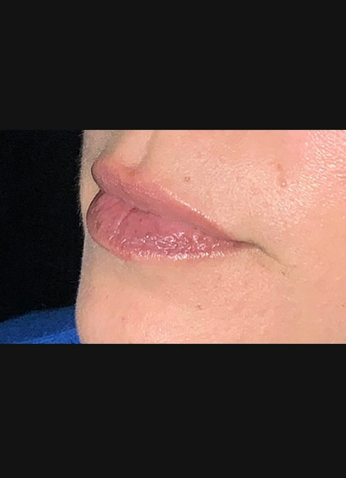 Lip Filler Before & After Gallery - Patient 104077 - Image 4