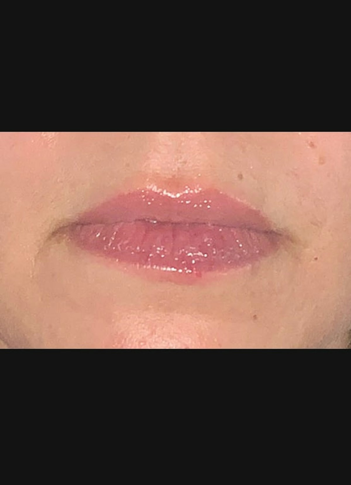 Lip Filler Before & After Gallery - Patient 104077 - Image 1