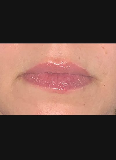 Lip Filler Before & After Gallery - Patient 104077 - Image 1