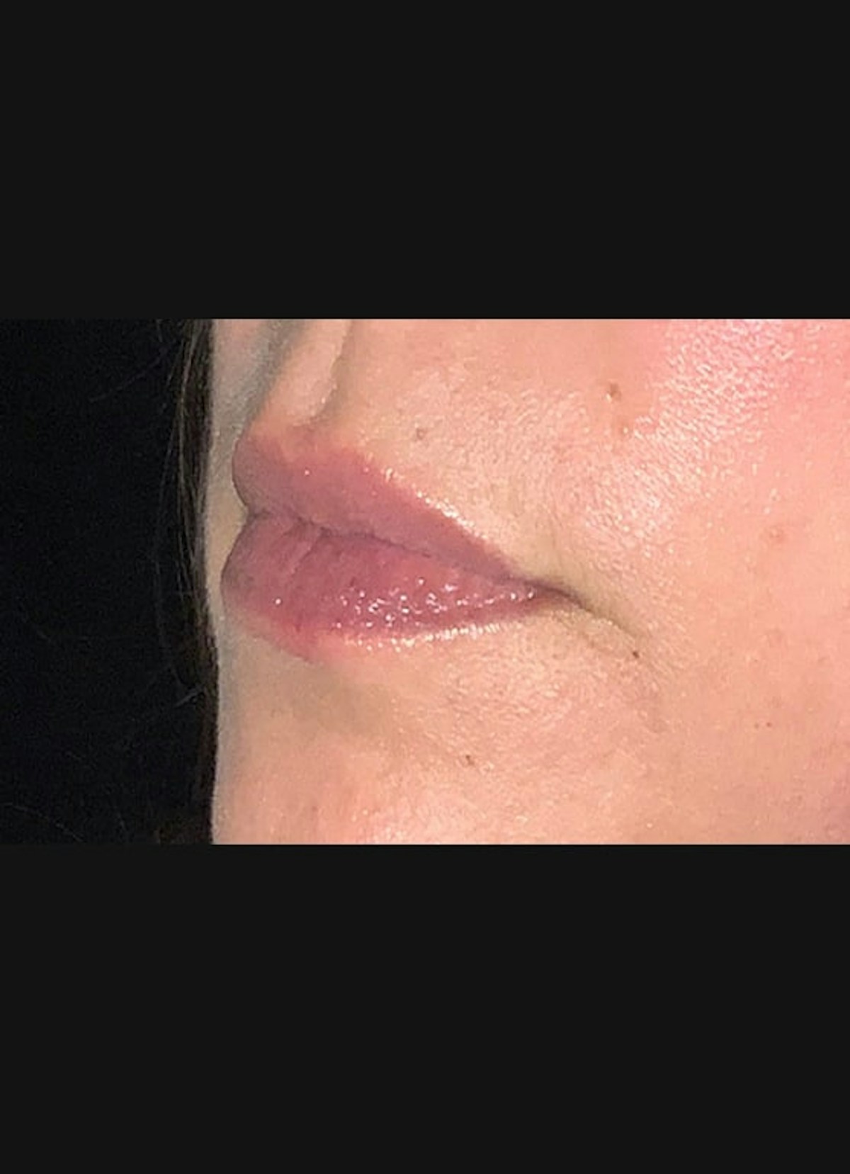 Lip Filler Before & After Gallery - Patient 104077 - Image 3