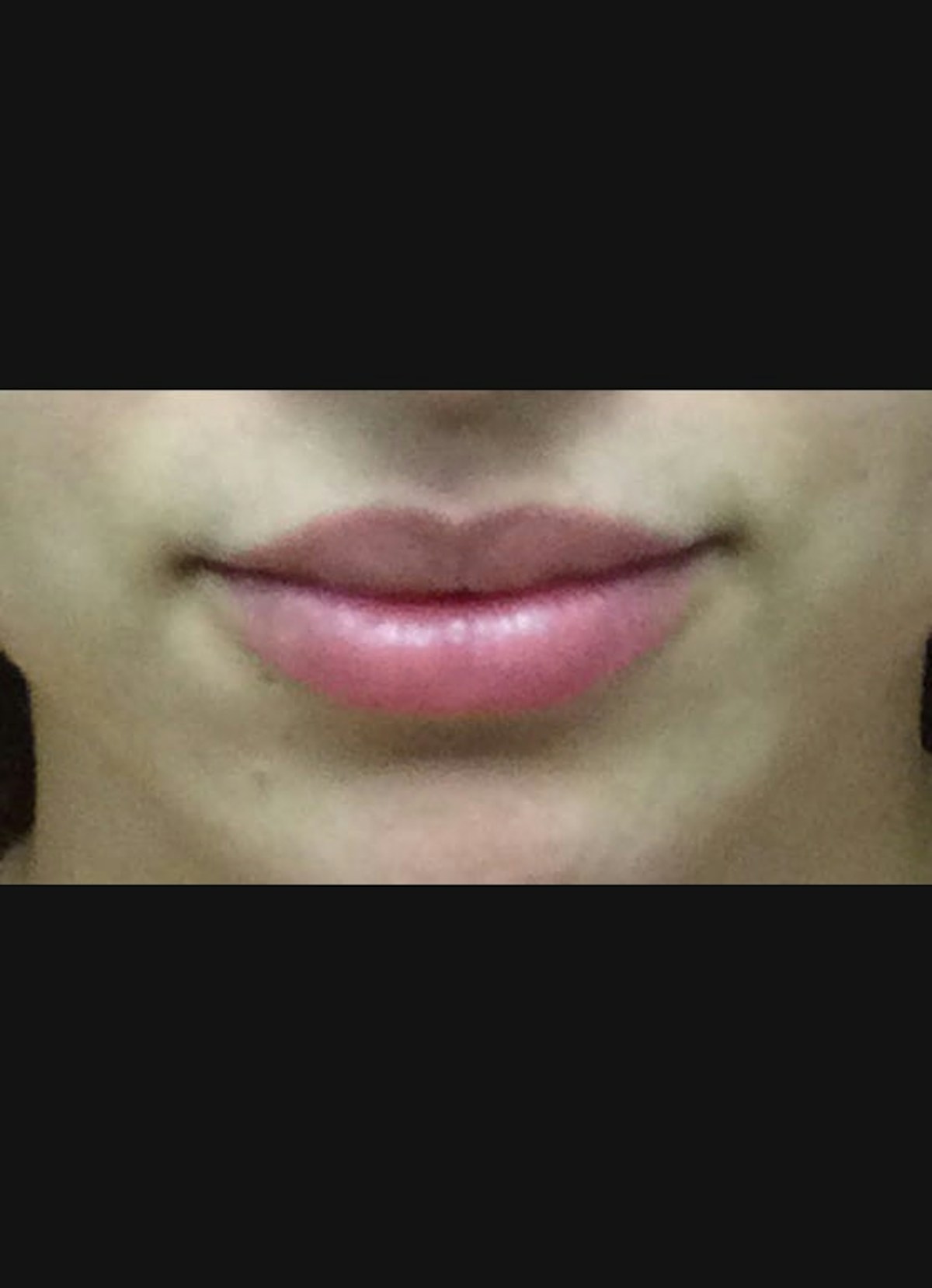 Lip Filler Before & After Gallery - Patient 151266 - Image 2