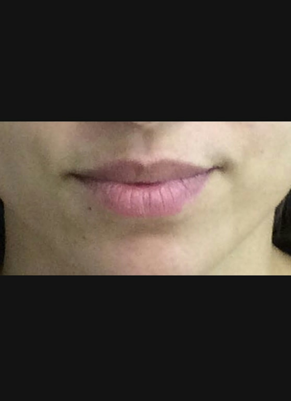 Lip Filler Before & After Gallery - Patient 151266 - Image 1