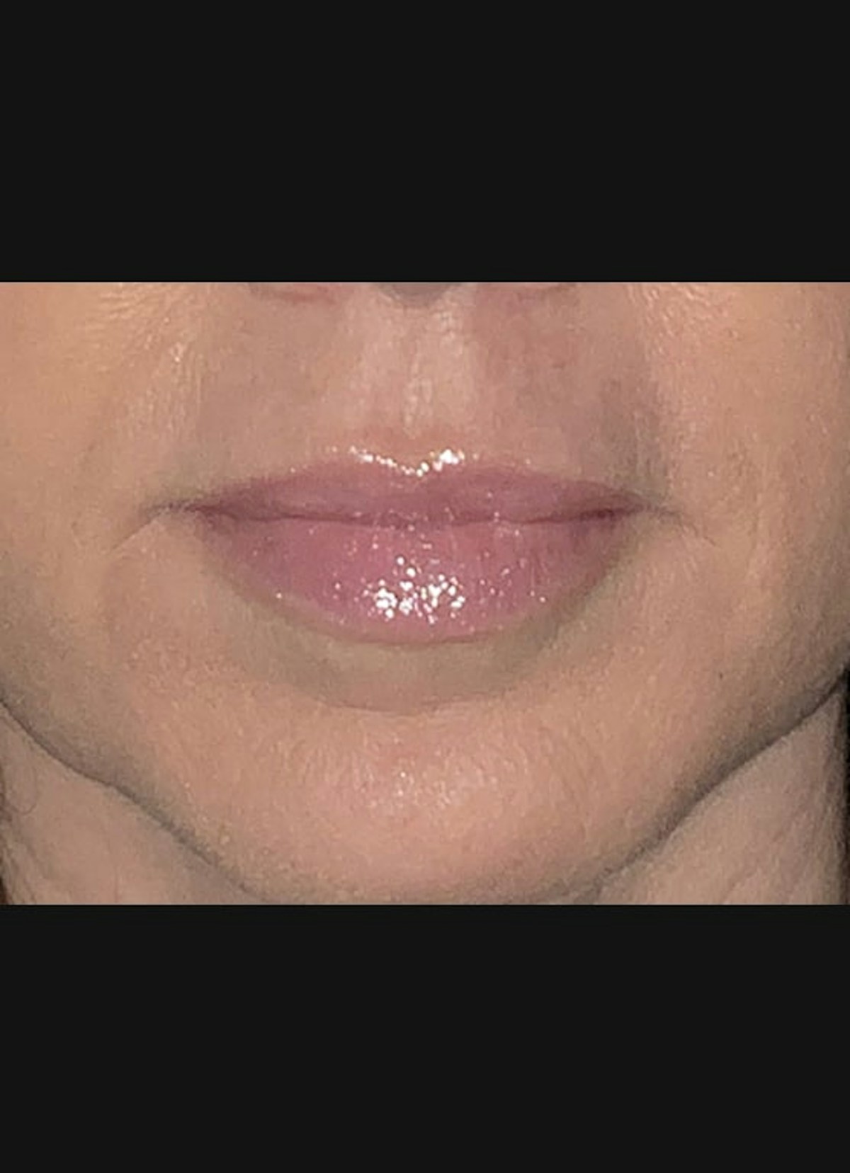 Lip Filler Before & After Gallery - Patient 307556 - Image 4