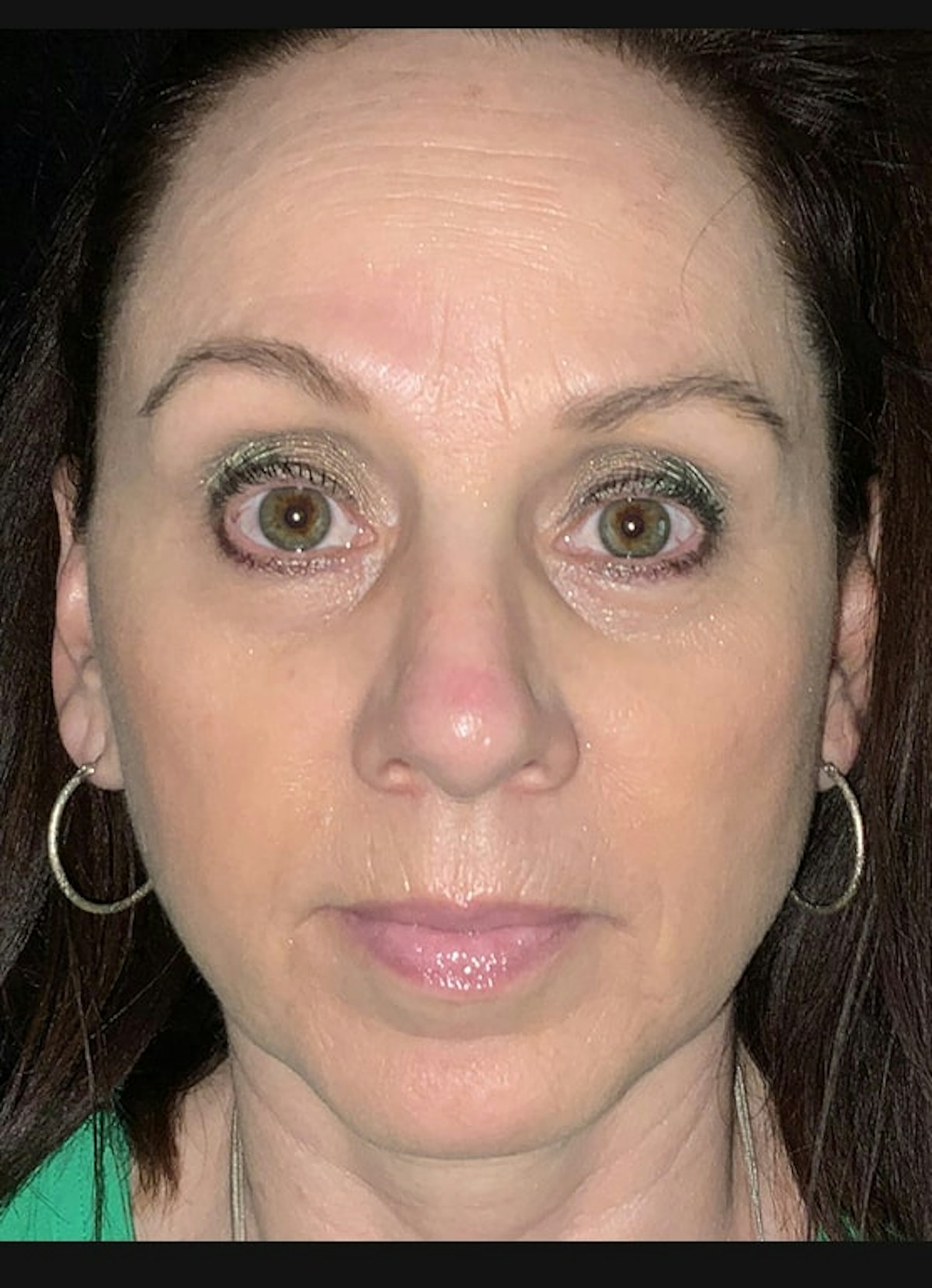 Lip Filler Before & After Gallery - Patient 307556 - Image 1