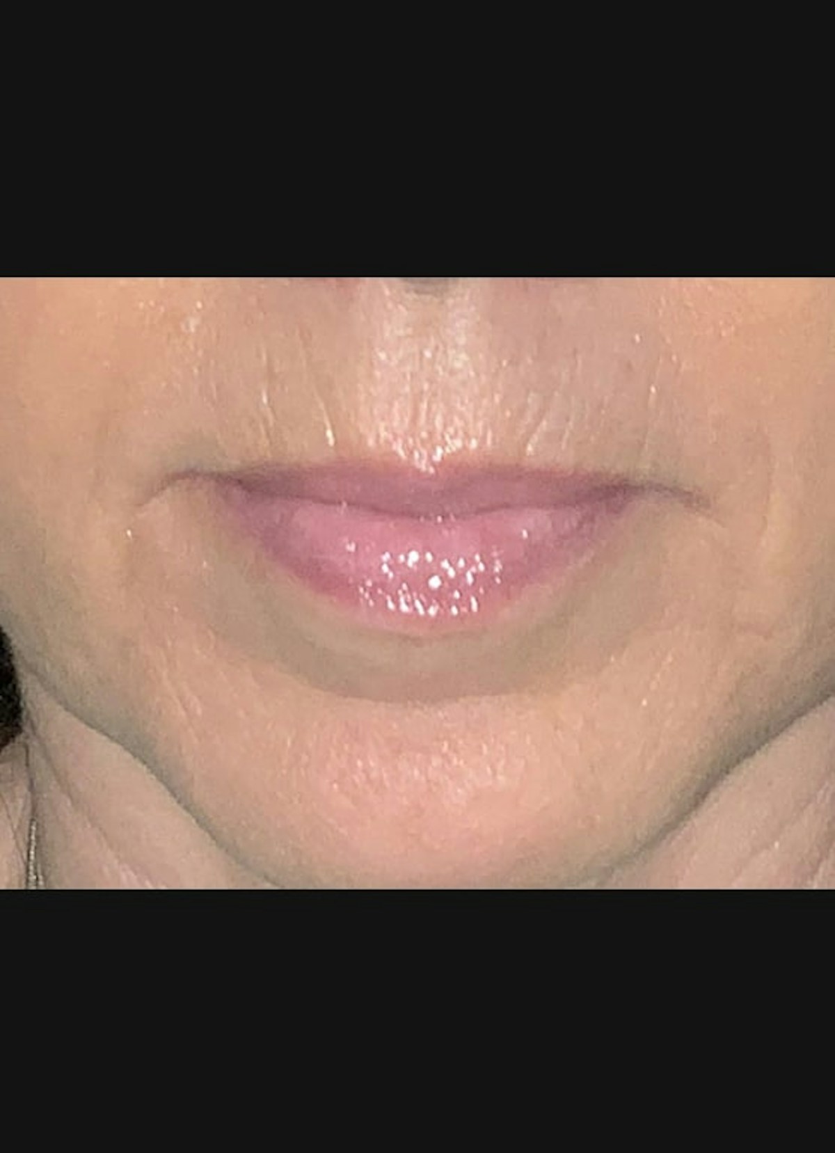 Lip Filler Before & After Gallery - Patient 307556 - Image 3