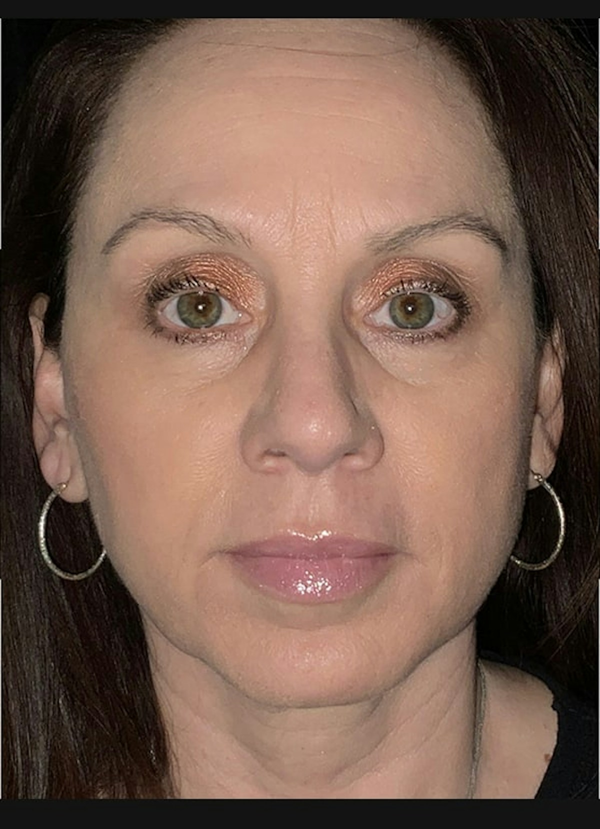Lip Filler Before & After Gallery - Patient 307556 - Image 2