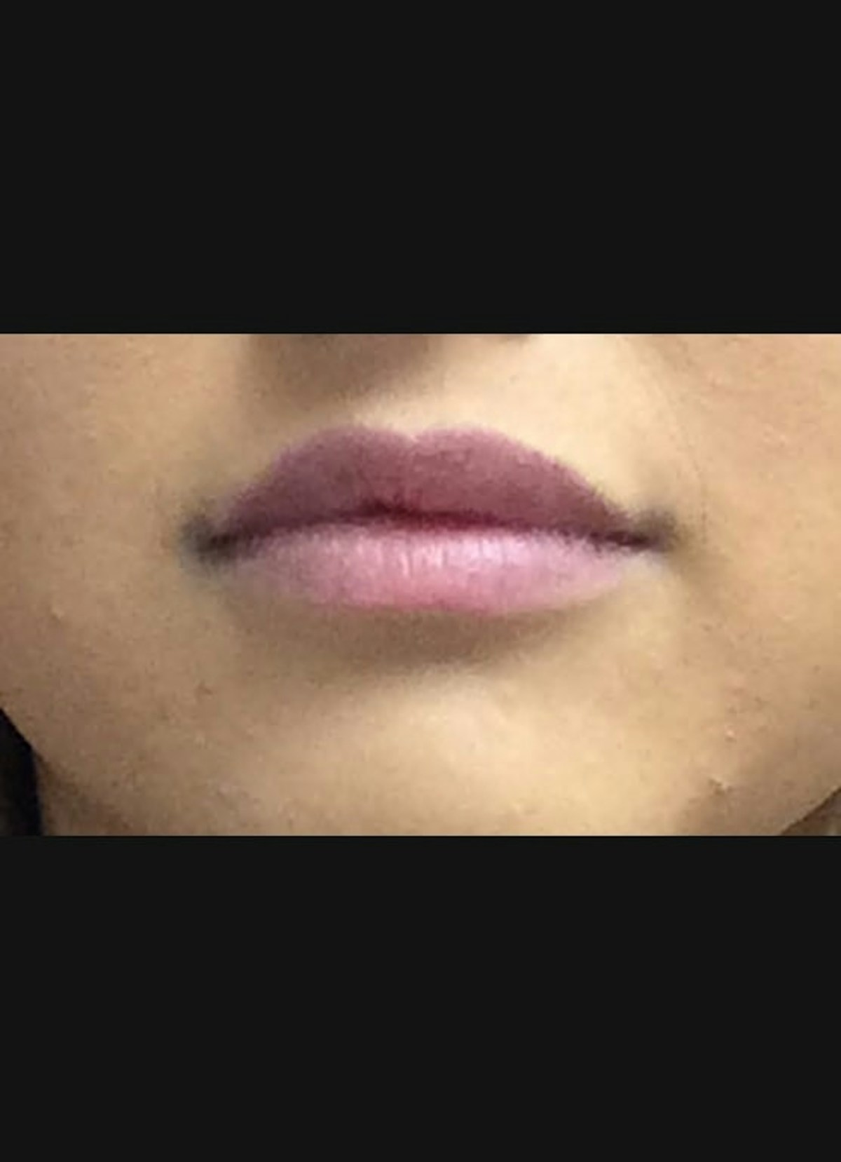 Lip Filler Before & After Gallery - Patient 415775 - Image 2