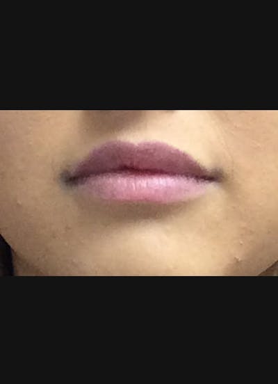 Lip Filler Before & After Gallery - Patient 415775 - Image 2
