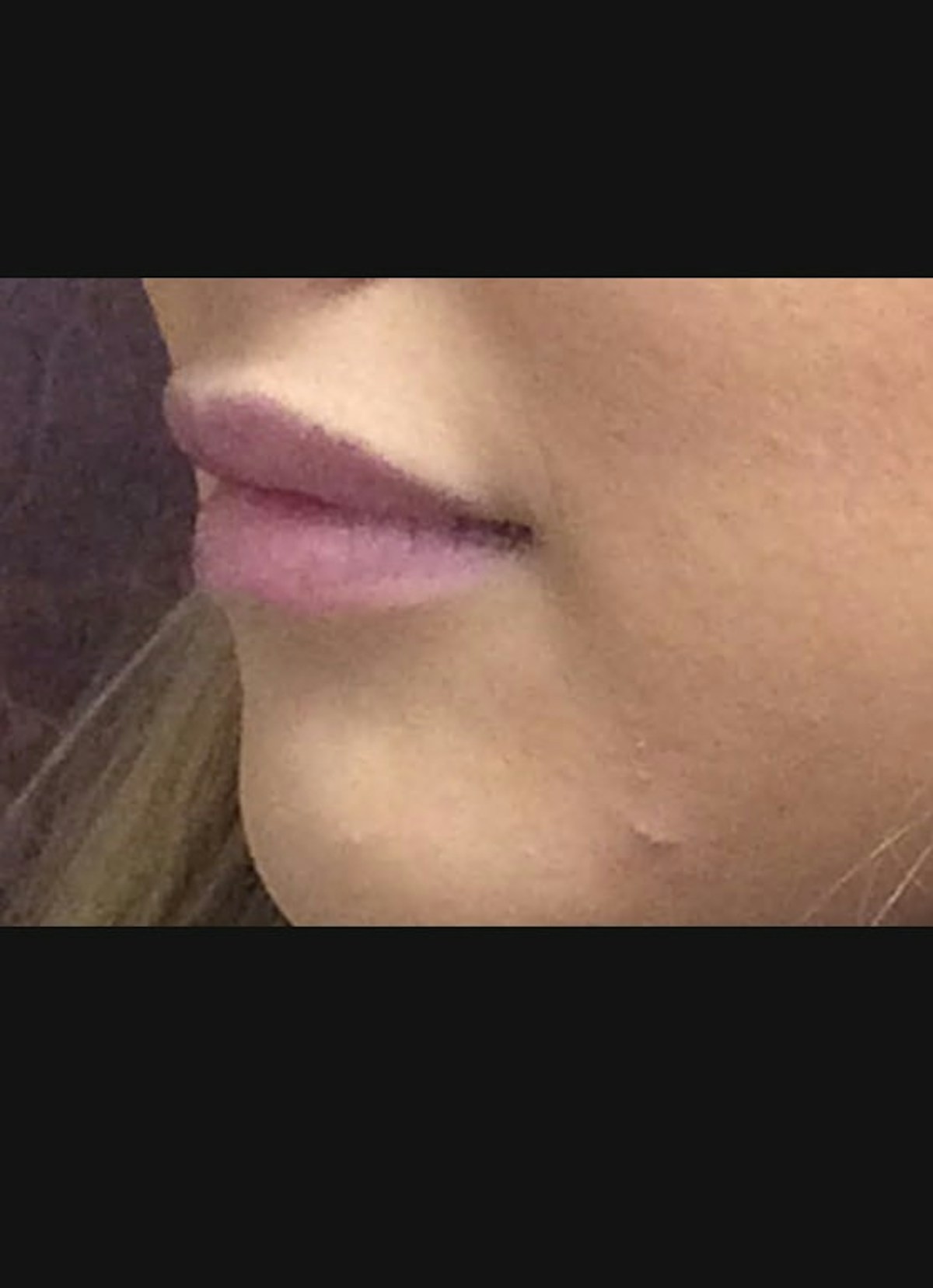 Lip Filler Before & After Gallery - Patient 415775 - Image 4