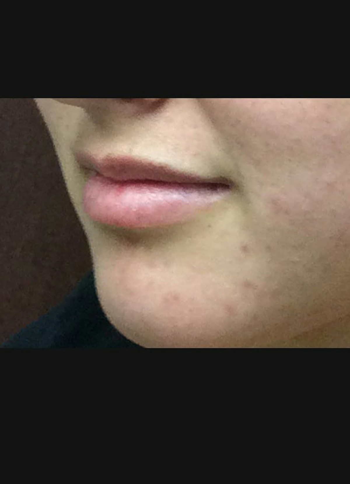 Lip Filler Before & After Gallery - Patient 415775 - Image 3