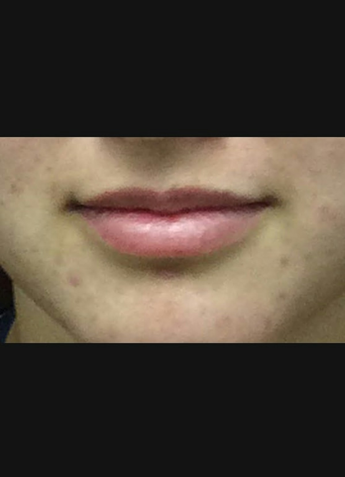 Lip Filler Before & After Gallery - Patient 415775 - Image 1