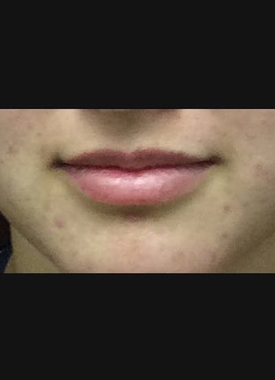Lip Filler Before & After Gallery - Patient 415775 - Image 1