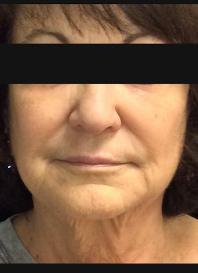 Lower Face Before & After Gallery - Patient 268294 - Image 2