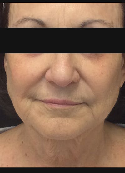 Lower Face Before & After Gallery - Patient 268294 - Image 1