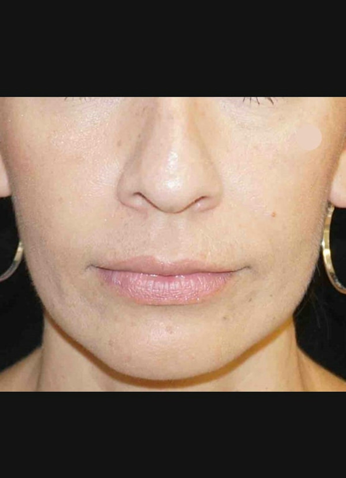 Nasolabial Folds Before & After Gallery - Patient 246779 - Image 2