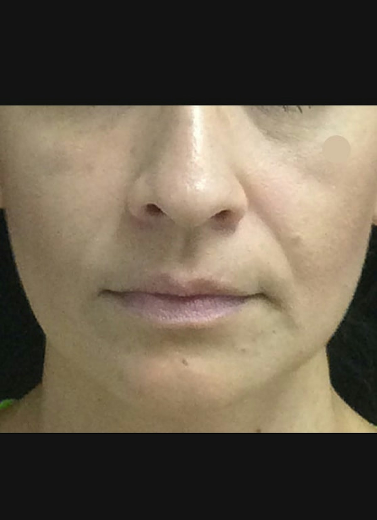 Nasolabial Folds Before & After Gallery - Patient 246779 - Image 1