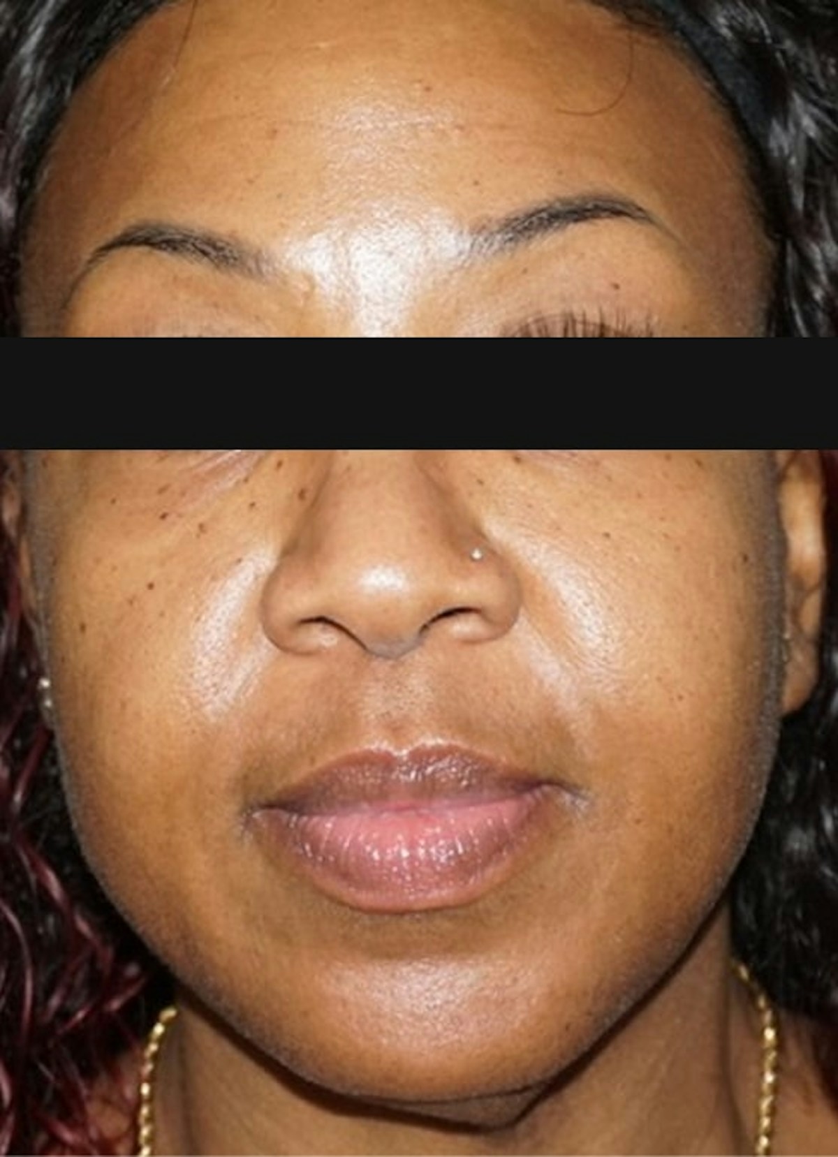 Nasolabial Folds Before & After Gallery - Patient 299409 - Image 2